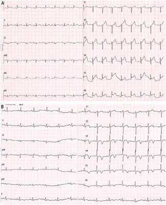 ST-Segment Elevation Myocardial Infarction Related to Potential Spontaneous Coronary Thrombosis in Pheochromocytoma Crisis